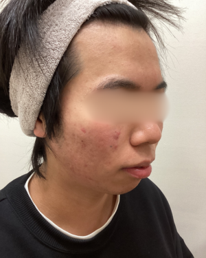頬の赤み治療(ACRS 3回)の症例写真[ビフォー]