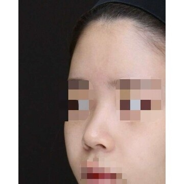 聖心美容クリニックの鼻の症例写真[ビフォー]