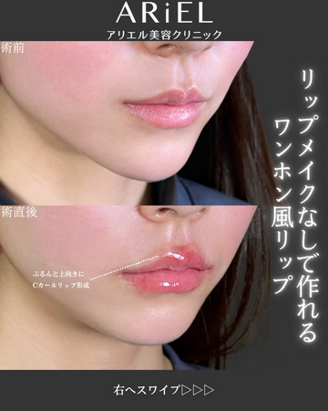 アリエル美容クリニック 郡山院の口元・唇の整形・人中短縮の症例写真