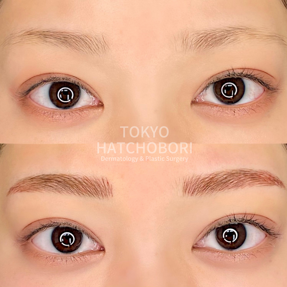 眉のアートメイク 初回 眉のアートメイクの症例写真 画像 東京八丁堀皮膚科 形成外科 Cs 美容医療の口コミ広場