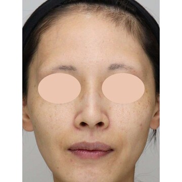 聖心美容クリニックの鼻の症例写真[ビフォー]