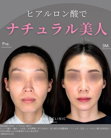KNOT CLINIC AOYAMAの輪郭・顎・エラ・額・小顔整形の症例写真