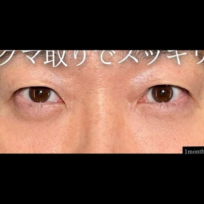 クマ取り×ヒアルで膨らみを改善👏🏻の症例写真[アフター]