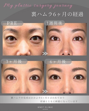 KNOT CLINIC AOYAMAの目元・クマ・眉下・涙袋整形の症例写真