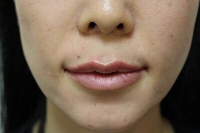 鼻の下の長さを短く見せるヒアルロン酸注入 その他 口元の整形 の症例写真 画像 あきこクリニック Cs 美容医療の口コミ広場