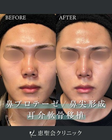 恵聖会クリニックの鼻の整形の症例写真