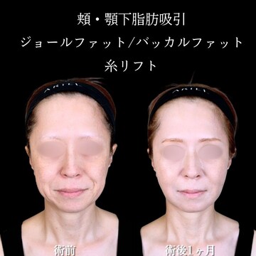 アリエル美容クリニック 大宮院の脂肪吸引の症例写真