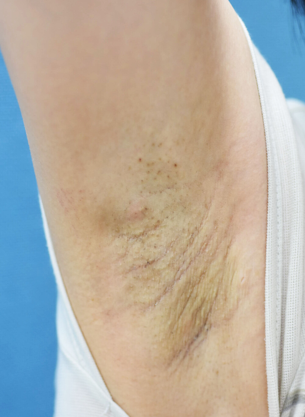 わきの黒ずみ対策 ボディトーニング その他 美容皮膚科 の症例写真 画像 みずほクリニック Cs 美容医療の口コミ広場