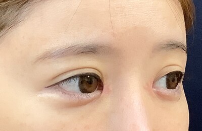 他院目頭切開術後の症例写真[アフター]