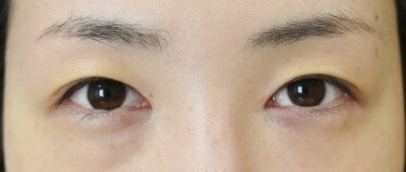 他院目頭切開術後修正の症例写真