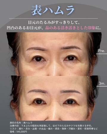 KNOT CLINIC AOYAMAの目元・クマ・眉下・涙袋整形の症例写真