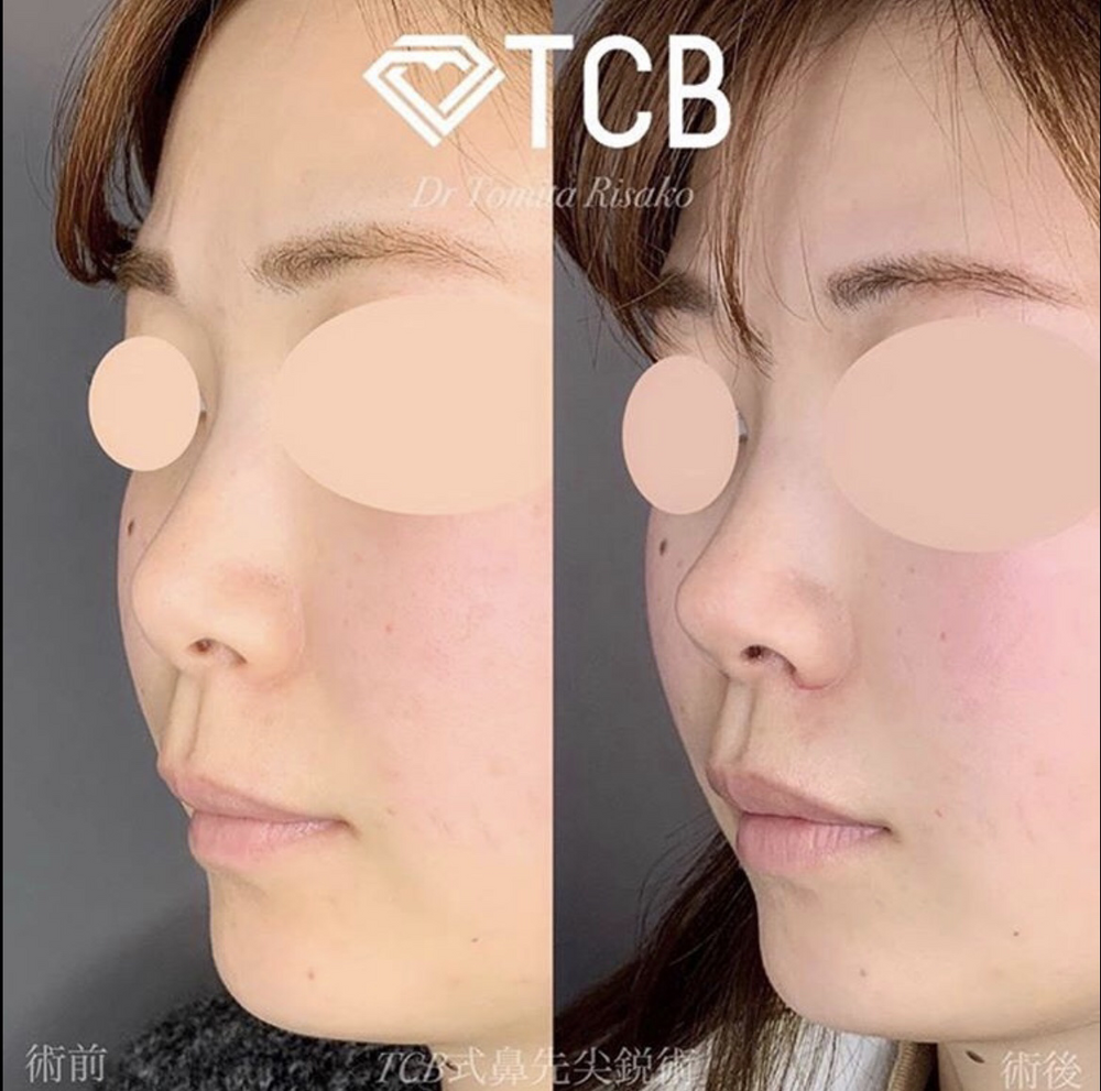 ツンとした鼻先で横顔美人 鼻の整形の症例写真 画像 Tcb東京中央美容外科 渋谷西口院 Cs 美容医療の口コミ広場