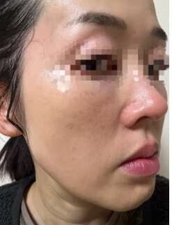 ペルラクリニック神宮前のリフトアップの症例写真[ビフォー]