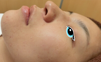 ジェネシスレーザーで毛穴をきれいに！！！の症例写真[ビフォー]