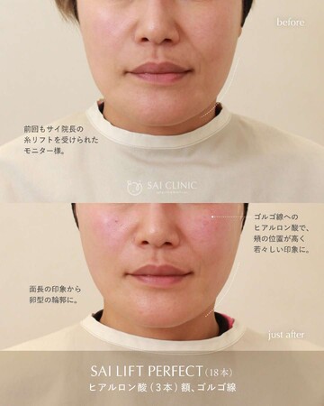 SAI CLINIC （サイクリニック）のリフトアップの症例写真