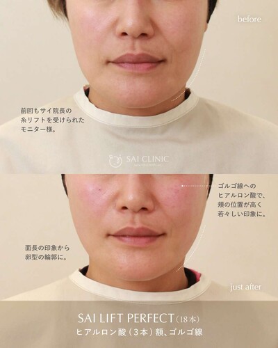 SAI LIFT PERFECT＋ヒアルロン酸 3ccの症例写真