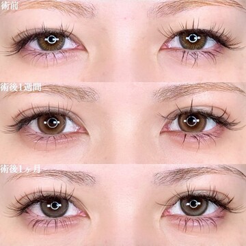 アリエル美容クリニック 大宮院の二重の症例写真