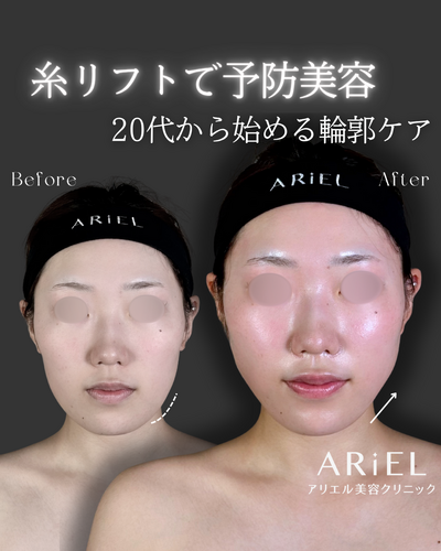 糸リフトの症例写真