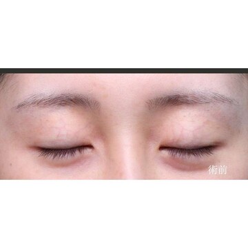 聖心美容クリニックの二重の症例写真[ビフォー]