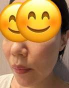 ペルラクリニック神宮前のリフトアップの症例写真[ビフォー]