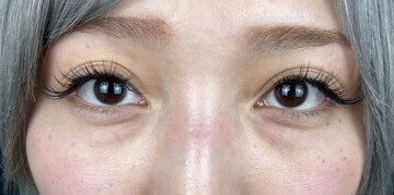 AI Beauty Clinicの目元・クマ・眉下・涙袋整形の症例写真[ビフォー]
