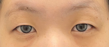 ユア美容クリニック 福岡院の二重の症例写真[ビフォー]