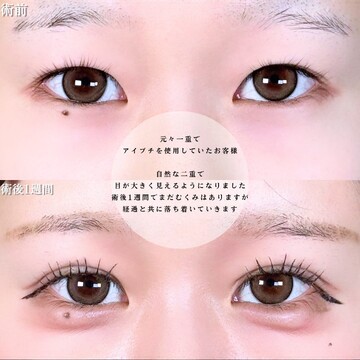 アリエル美容クリニック 大宮院の二重の症例写真