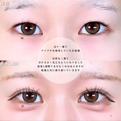 アリエルクイックループトリプル二重埋没法/涙袋ヒアルロン酸の症例写真