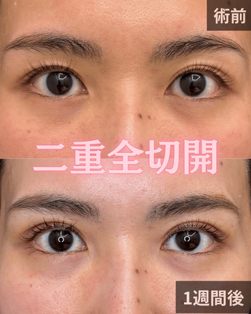 CHARIS BEAUTY CLINICの目・二重整形の症例写真