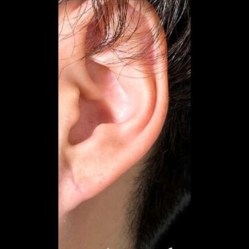 PRISM Beauty Clinicの症例写真[アフター]