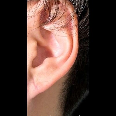 耳垂裂修正の症例写真[アフター]