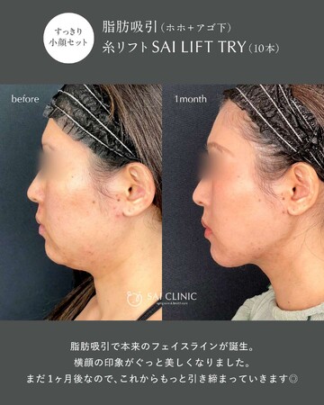 SAI CLINIC （サイクリニック）のリフトアップの症例写真
