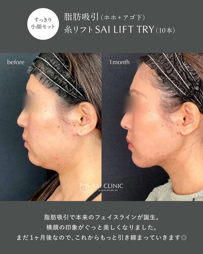 【30代】サクションリフト（脂肪吸引＋糸リフト）の症例写真