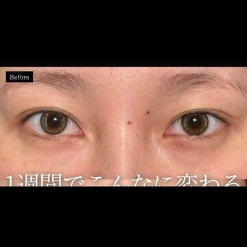 PRISM Beauty Clinicの二重の症例写真[ビフォー]