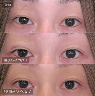 アーティスクリニックの目・二重整形の症例写真