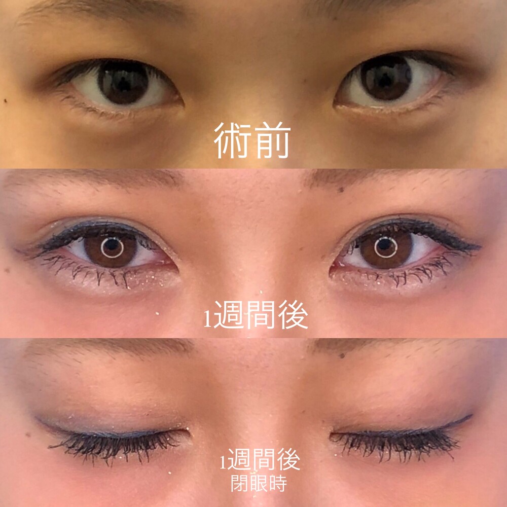 クイックコスメティークダブル 手術直後からフルメイク可能 二重埋没法の症例写真 画像 湘南美容クリニック 藤沢院 Cs 美容医療の口コミ広場