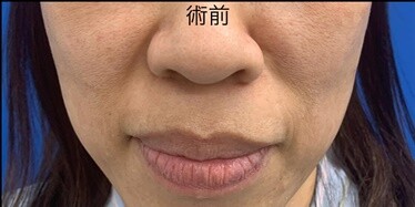50代女性のほうれい線脂肪注入の症例写真[ビフォー]