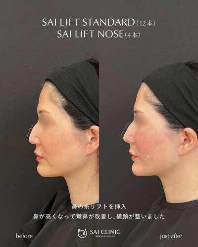 糸リフト（SAI LIFT STANDARD）＋ 鼻糸リフトの症例写真