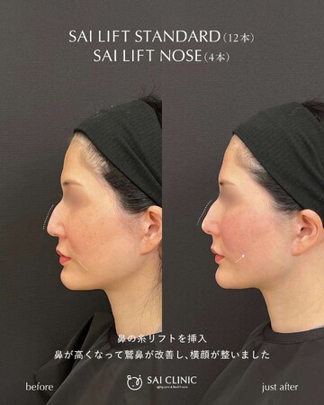 SAI CLINIC （サイクリニック）のリフトアップの症例写真