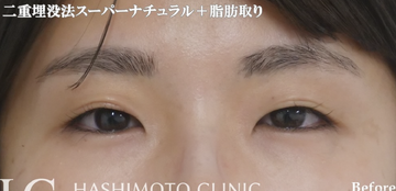静岡美容外科橋本クリニックの目・二重整形の症例写真[ビフォー]