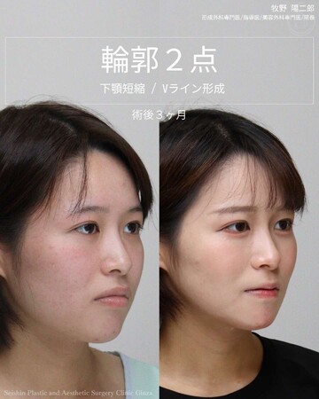 聖心美容クリニックの輪郭・顎・エラ・額・小顔整形の症例写真