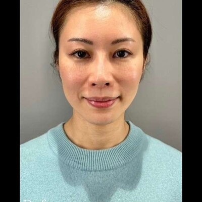 アルテミスリフト８本の症例写真[ビフォー]
