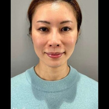 PRISM Beauty Clinicのリフトアップの症例写真[ビフォー]