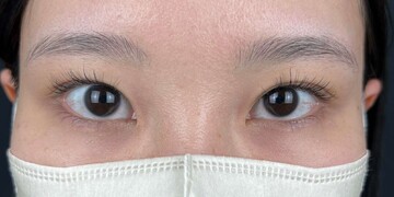 AI Beauty Clinicの二重の症例写真[ビフォー]