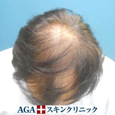 Rebirth+Dr’sメソ｜50代｜8ヶ月の症例写真[ビフォー]