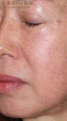 目下のたるみ ほうれい線 マリオネットライン 50代女性 その他 顔のしわ たるみ ほうれい線の整形の症例写真 画像 肌と歯のクリニック 東京ベイ幕張 Cs 美容医療の口コミ広場