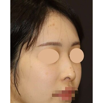 聖心美容クリニックの鼻の症例写真[ビフォー]