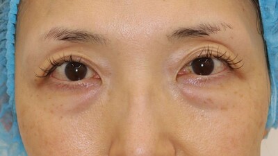 下瞼脱脂の症例写真[ビフォー]