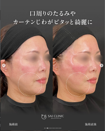 SAI CLINIC （サイクリニック）のリフトアップの症例写真