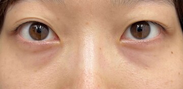 AI Beauty Clinicの目元・クマ・眉下・涙袋整形の症例写真[ビフォー]